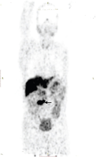 Positron emission tomography scan showing expression of somatostatin receptor 2 in mesenteric mass and right paracaval lymph node.